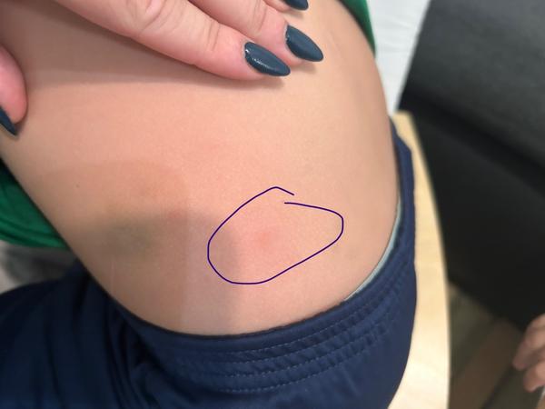 Štípance na těle – jsou to štěnice?