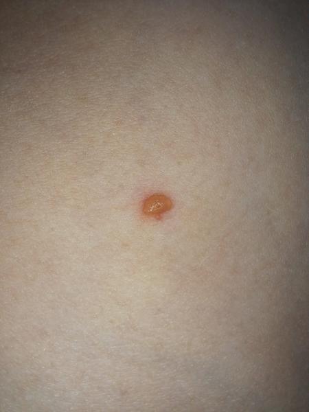 Jen jedna neštovice. Je to možné?