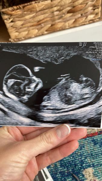 Je to chlapeček nebo holčička podle ultrazvuku?