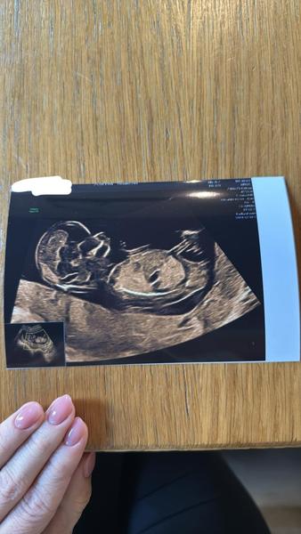 Je pohlaví určené při screeningu spolehlivé?