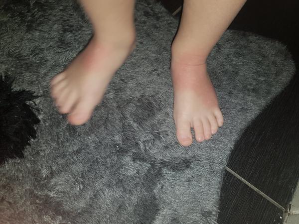 Co způsobuje pupínky u dětí a jak je léčit?