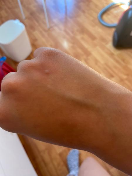 Jak poznat příznaky svrabu a jak předcházet nákaze?