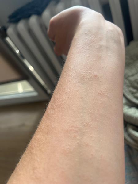 Jak rozeznat svrab od jiných kožních problémů?