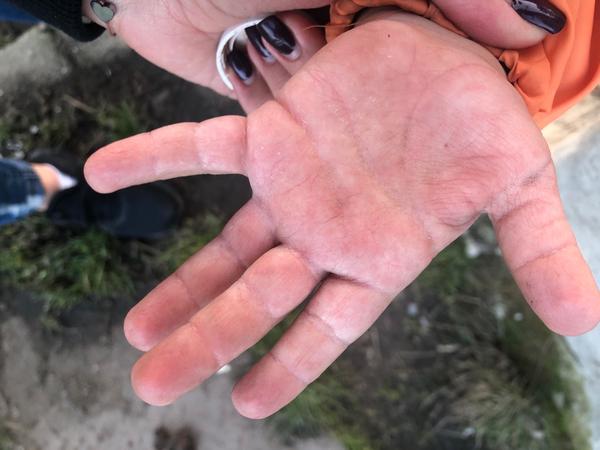 Fleky na dlaních. Co by to mohlo být?