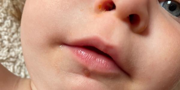 Jak rozpoznat opar a jak jej léčit?