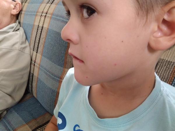 Nemoc noha ruka pusa nebo štípnutí od komára?