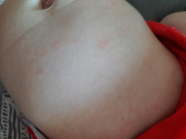 Něco na hrudi a bříšku. Mám se bát?