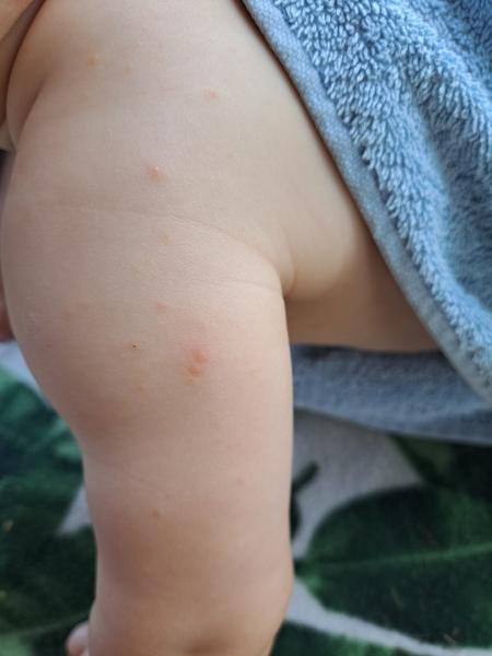 Červené pupínky na předloktí a lýtkách u miminka. Čím to může být?