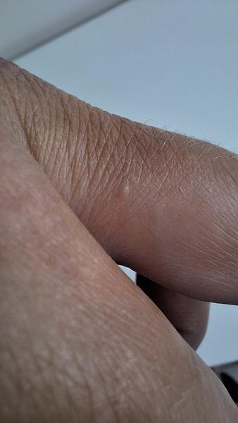 Pupínky na rukou. Může být příčinou scuhá pokožka?