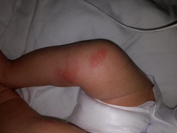 Vyrážka novorozence, co to je?