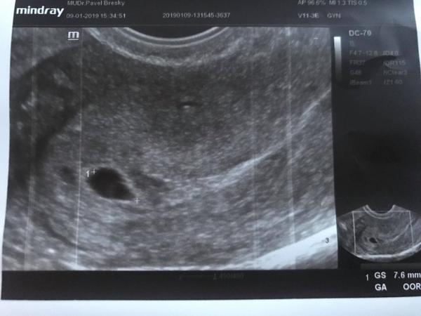 Antibiotika Furolin a Biseptol a vliv na vývoj plodu