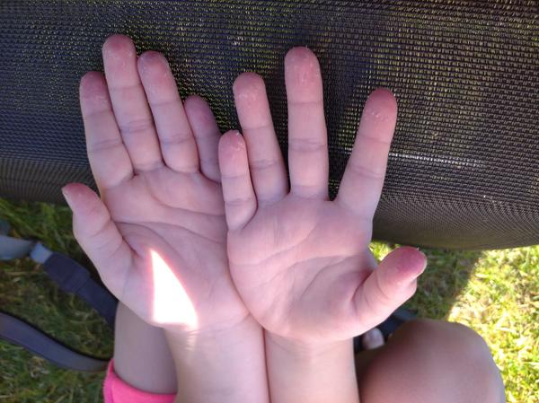 Červené flíčky a slouplé konečky prstů - doplnění fotografií loupající se kůže na bruskách prstů