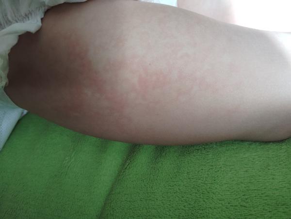 Zkušenosti s léčbou vyrážky. Co pomohlo vám?