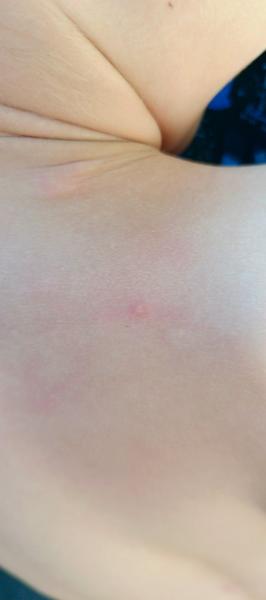 Pupínky na zádech u dítěte: Co to může znamenat?