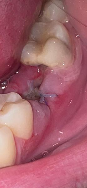 Jak vypadá rána po extrakci zubu po týdnu?