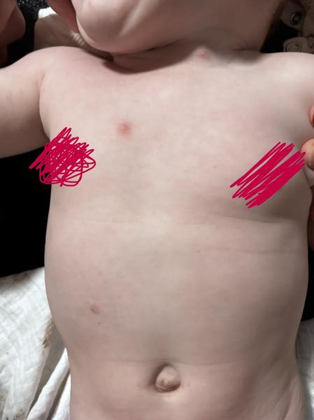 Pupínky na těle. Vypadá to na neštovice?