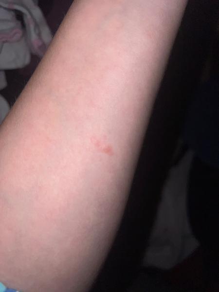 Pasový opar v těhotenství. Jaké jsou příznaky a rizika?