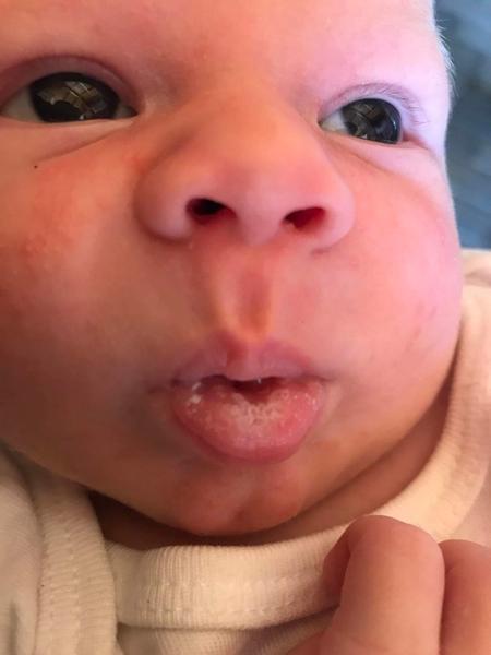 Jak účinně léčit moučnivku u měsíčního dítěte?