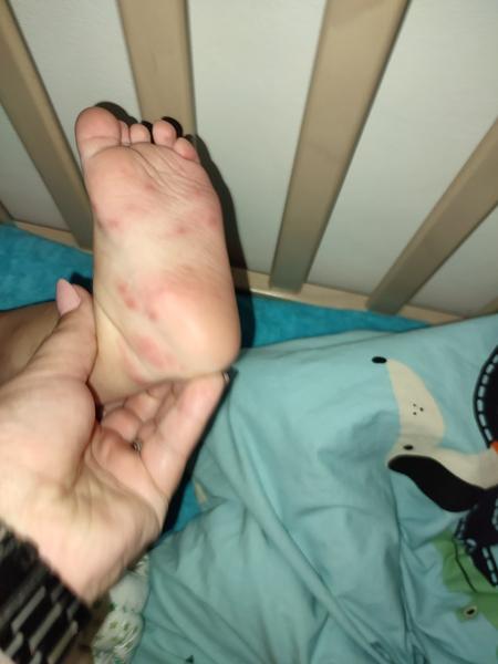 Vyrážka na noze po kontaktu s trávou a jahodami?