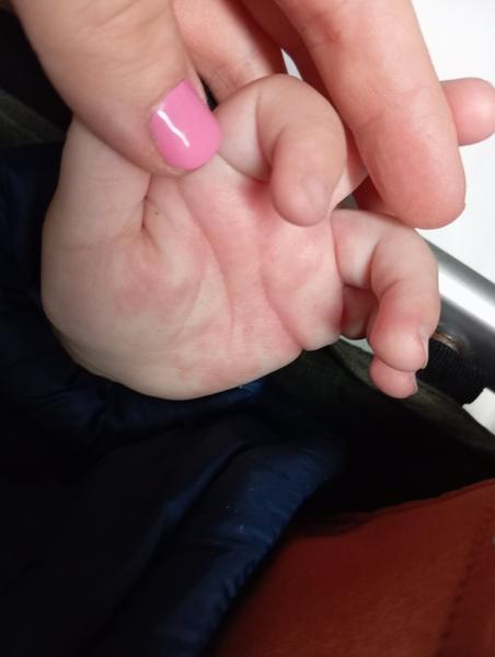 Jak řešit vyrážku na dlani u dítěte?