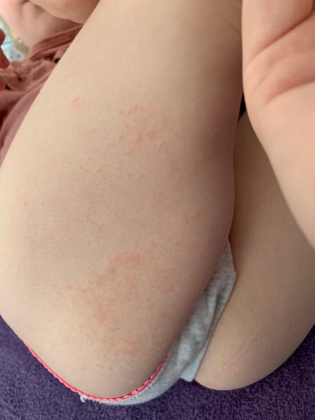 Jak rozpoznat ekzém u dítěte? Rychlé rozlézání vyrážky.