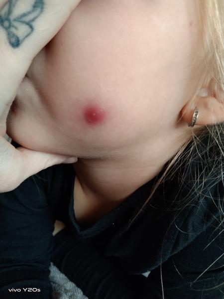 Jak se zbavit pupínku na tváři u dětí?