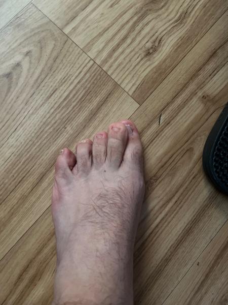Jak se zbavit bolesti u hallux valgus po operaci?