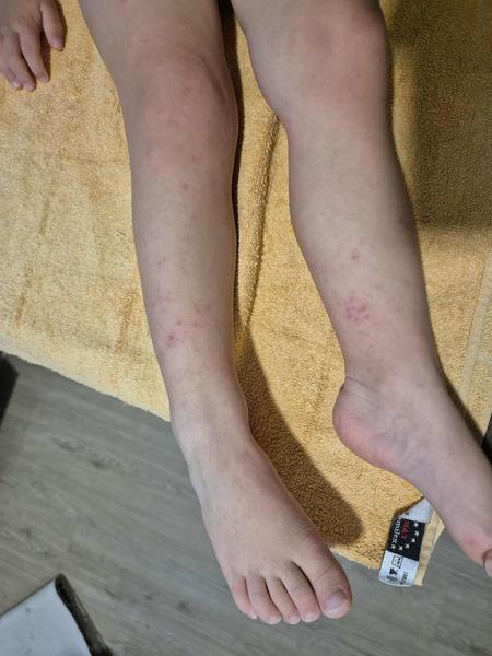 Neznámá vyrážka na nohou tříletého dítěte. Co by to mohlo být?