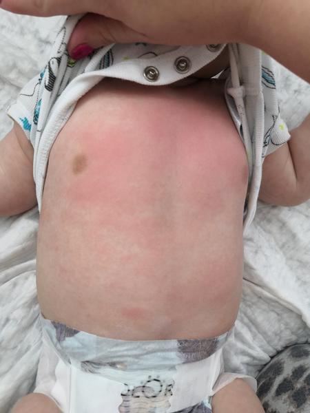 Potřebuji poradit. Co na zarudlé fleky na bříšku?