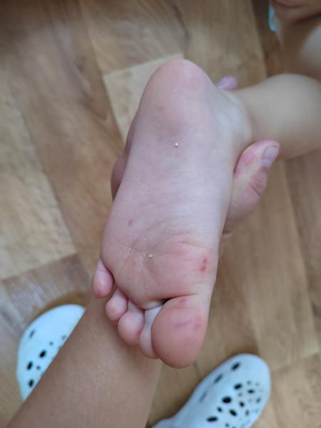 Divné pupínky u dítěte: Může to být nemoc ruka noha ústa?