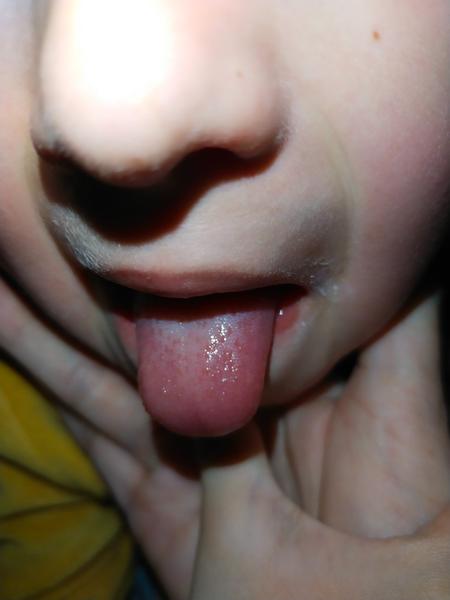 Je to spála? Symptomy a riziko pro sourozence