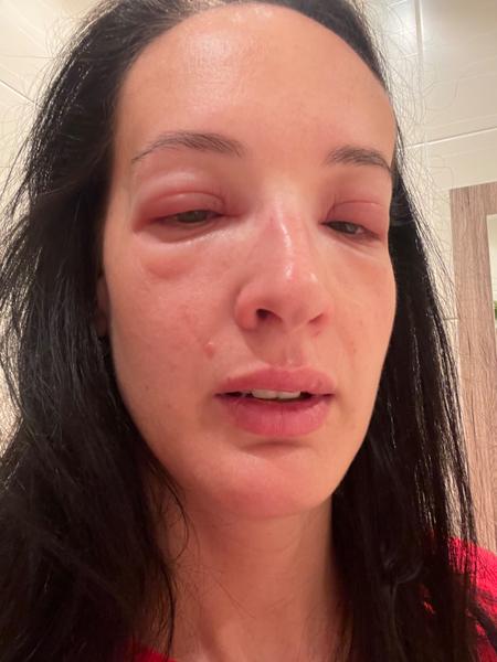 Extrémní alergie na sérum pro alergiky: Je to bezpečné?