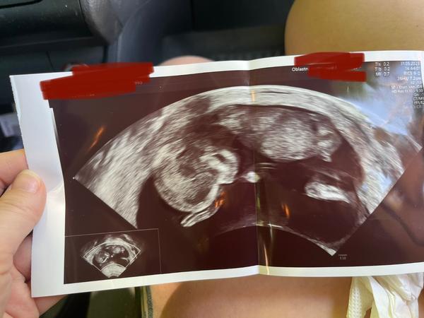 Růst pohlaví v 13. týdnu: Jak to vypadá na ultrazvuku?