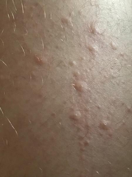 Svědivá kožní vyrážka: Co může být příčinou?