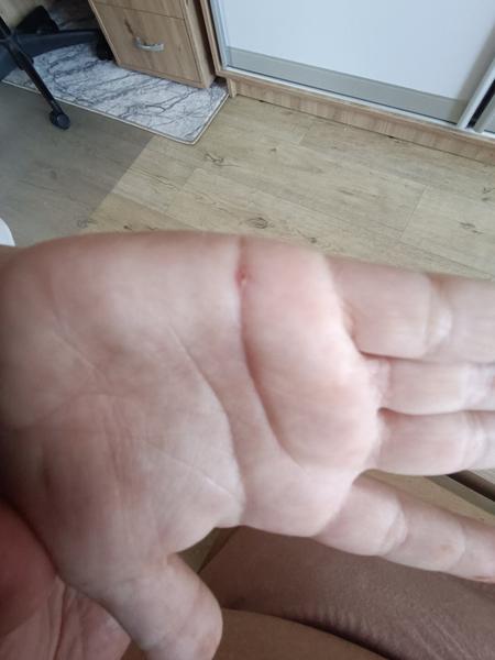 Vodnaté puchýřky na palcích rukou i nohou: Co to je?