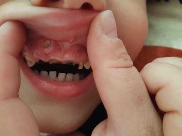 Zub u dítěte. Jak to řešit a přinutit dítě k ošetření?