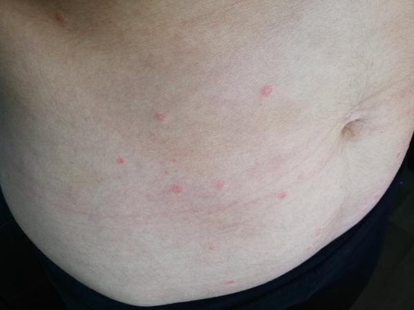 Neštovice podruhé ve 30 letech. Mohly by to být?