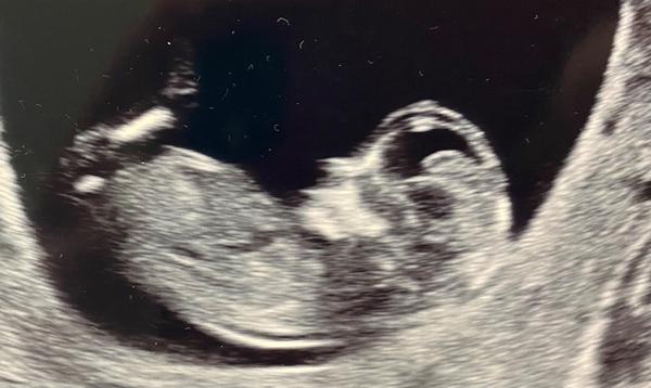 Vidíte na pohlavním hrbolku něco výrazného?