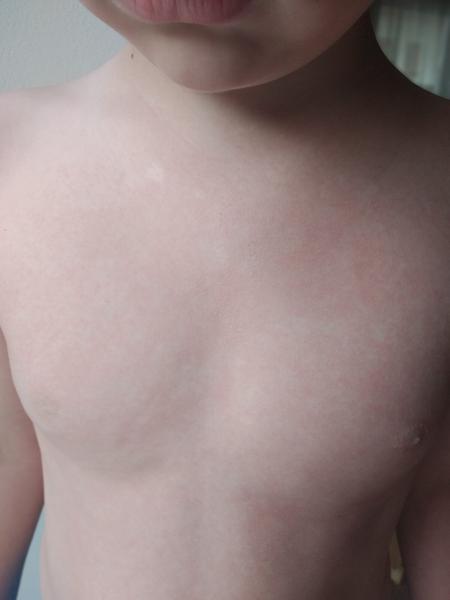 Vyrážka u dítěte: Co ji může způsobit?