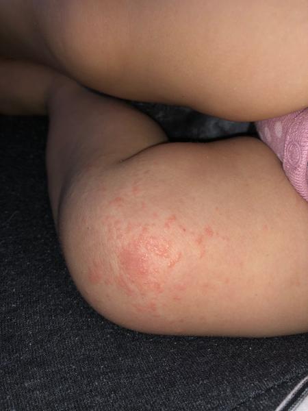 Vyrážka u dítěte. Co by to mohlo být?