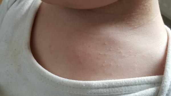 Vyrážka - jsou to potničky?