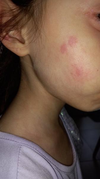 Alergie na Erythromycin u dcery? Zkušenosti a radu prosím!