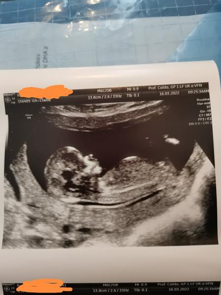 Lze určit pohlaví z fotky ze screeningu?