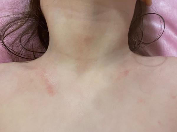 Je to atopický ekzém, nebo něco jiného? Zkušenosti rodičů