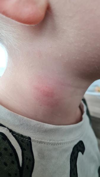 Unknown pupínek. Jak zjistit příčinu a léčbu?