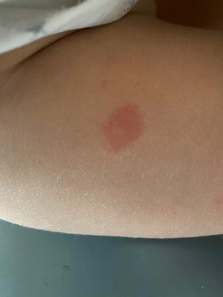 Červené fleky na kůži dítěte. Co to může být?