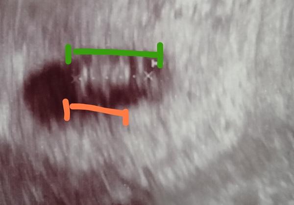 Jak rozeznat části ultrazvuku v těhotenství?