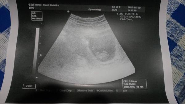 8+6tt, jak má vypadat foto z ultrazvuku?