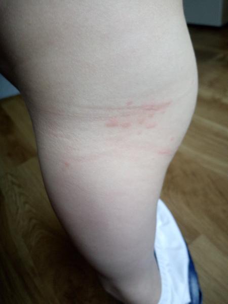 Mohou to být pupínky ze slunce?