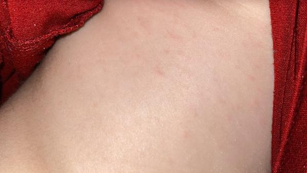 Vyrážka u tříletého dítěte. Jak to řešit?